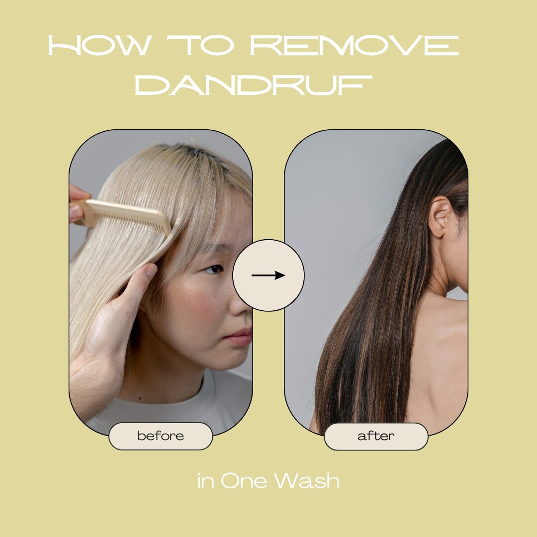 How to Remove Dandruff in One Wash